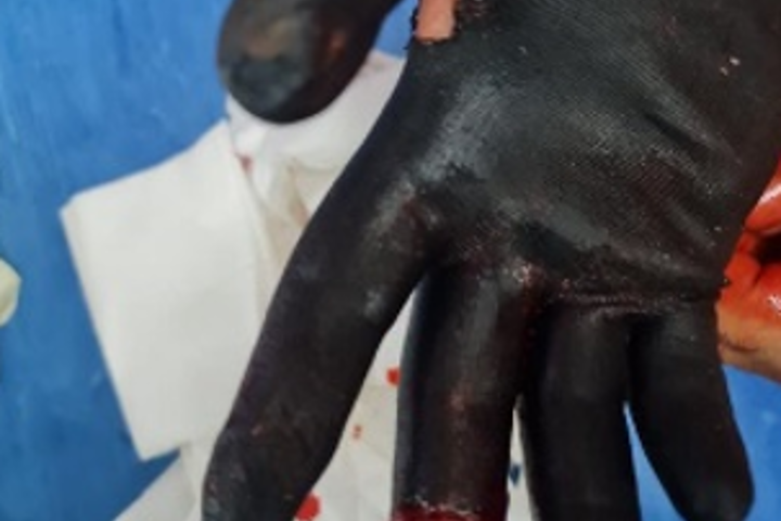 Glove prior to removal; damage to thumb area was pre-existing Glove prior to removal; damage to thumb area was pre-existing