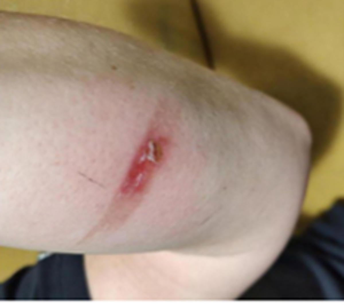 IMCA SF: MSF: Burn to arm from contact with tumble dryer 1 IMCA SF: MSF: Burn to arm from contact with tumble dryer 1