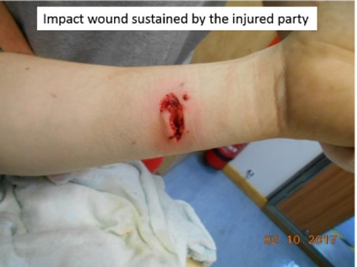 IMCA SF: Arm injury whilst using pillar drill Image6 (4) impact wound sustained by the injured party (IP)