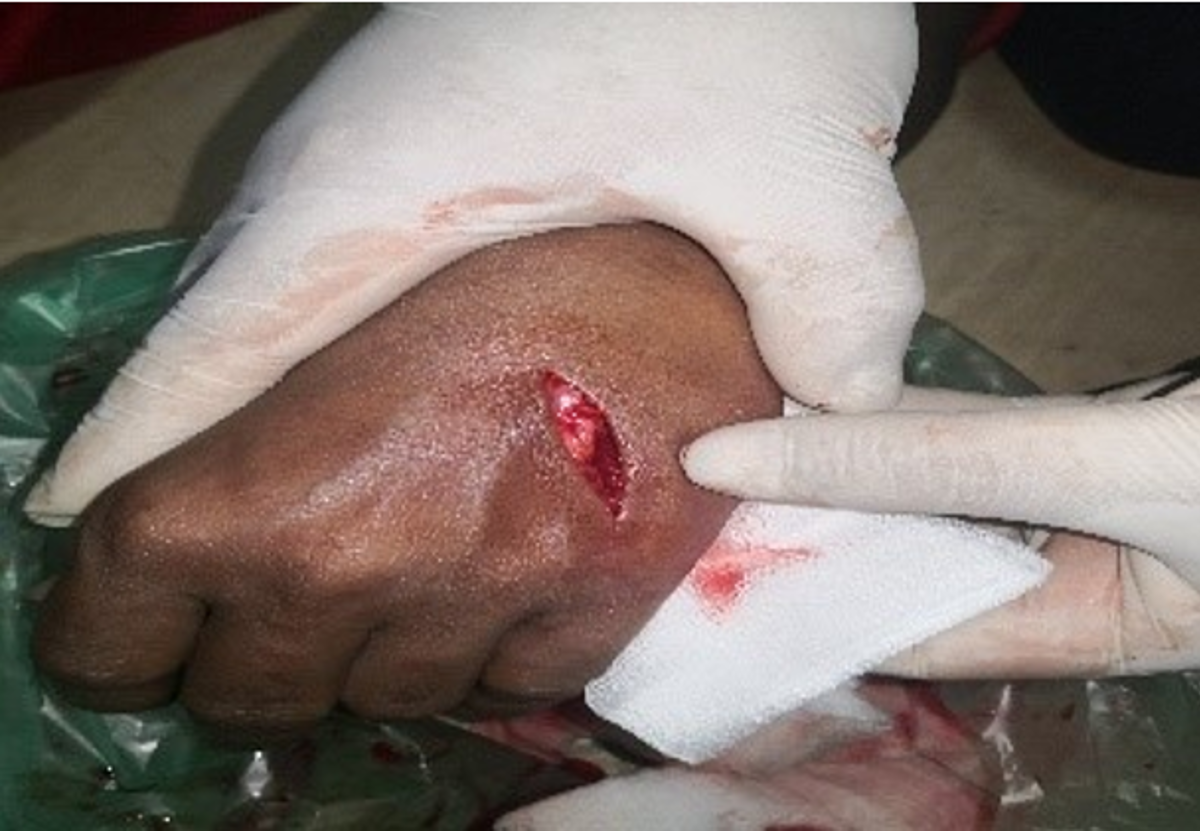 Photo of serious hand injury