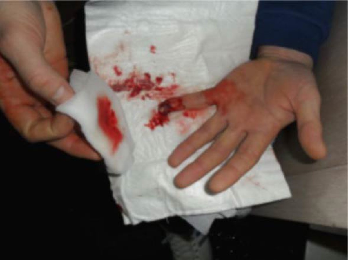 Lost time injury (LTI): Crewman’s finger pinched when moving the gangway