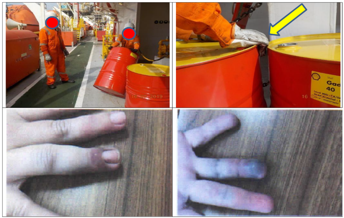 IMCA SF 09/20 LTI: Finger injury caused while working with oil drums A crewmember suffered a fracture to the right-hand ring finger whilst arranging 200l oil drums