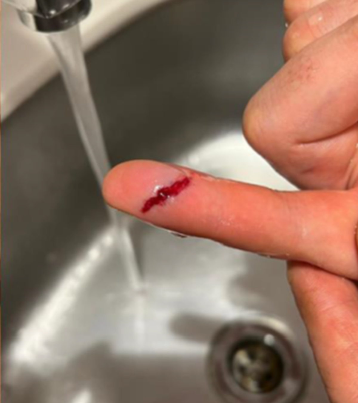 Hand and finger injuries