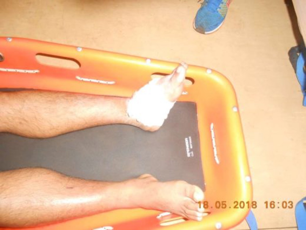 AB suffered serious ankle injuries