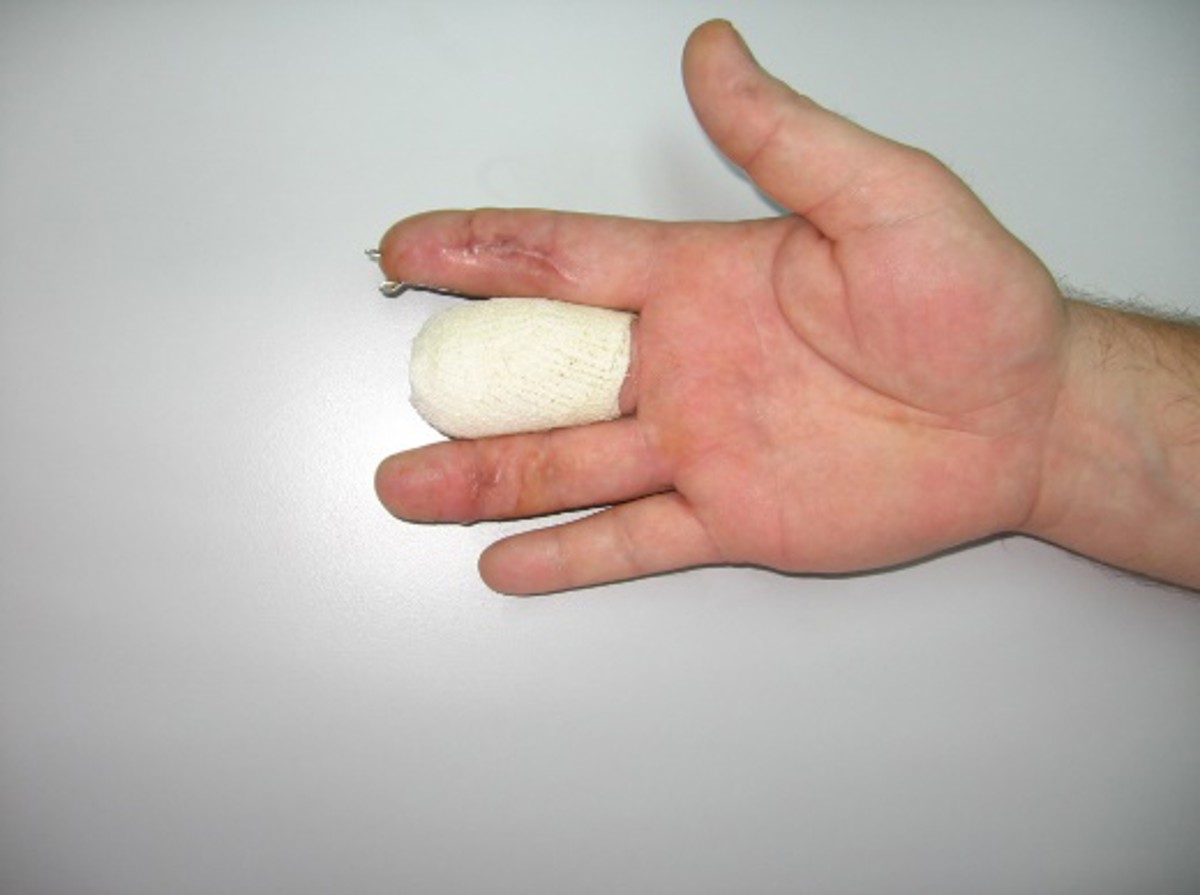 Post Driver Hand Injury Hand injury sustained by diver