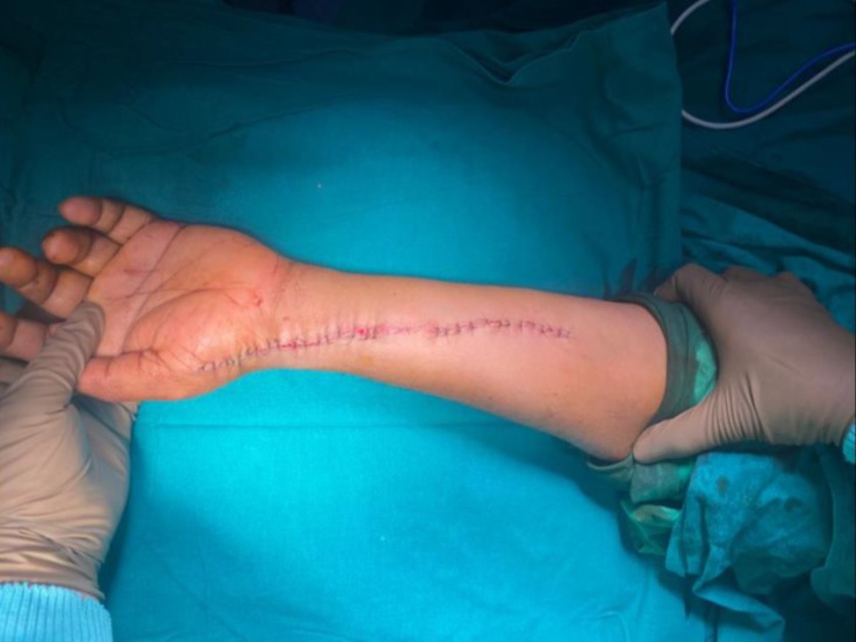 IMCA SF Watch your hands!! person injured while using an angle grinder Injured person made a full recovery after surgery