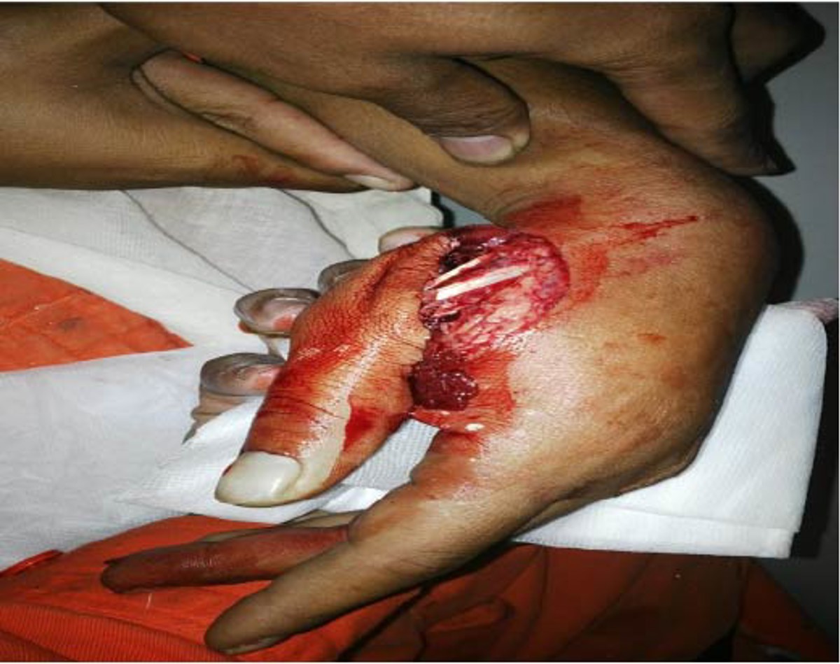 injuries to the crewman's hand