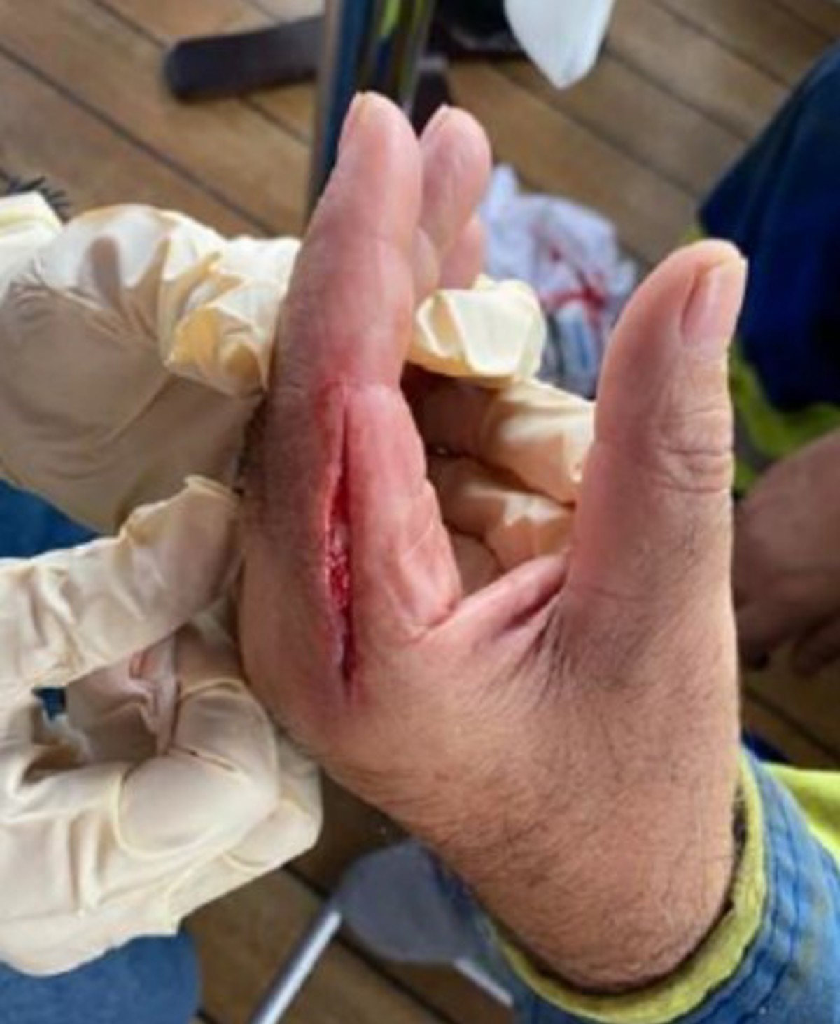He missed the sheath with the knife and pushed the knife into and down his left Index finger, causing a large deep  incision, requiring surgery to correct possible tendon damage, and close the wound.