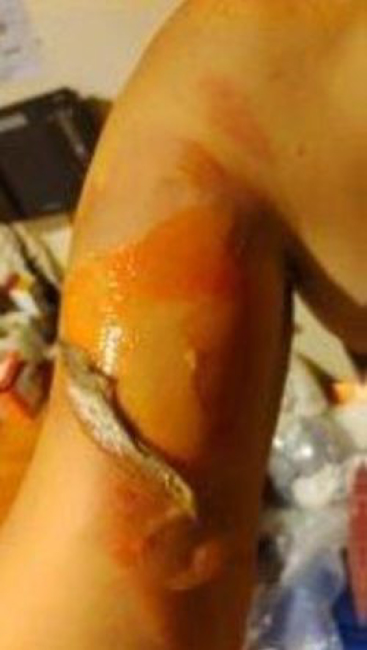 Injuries from scalding steam