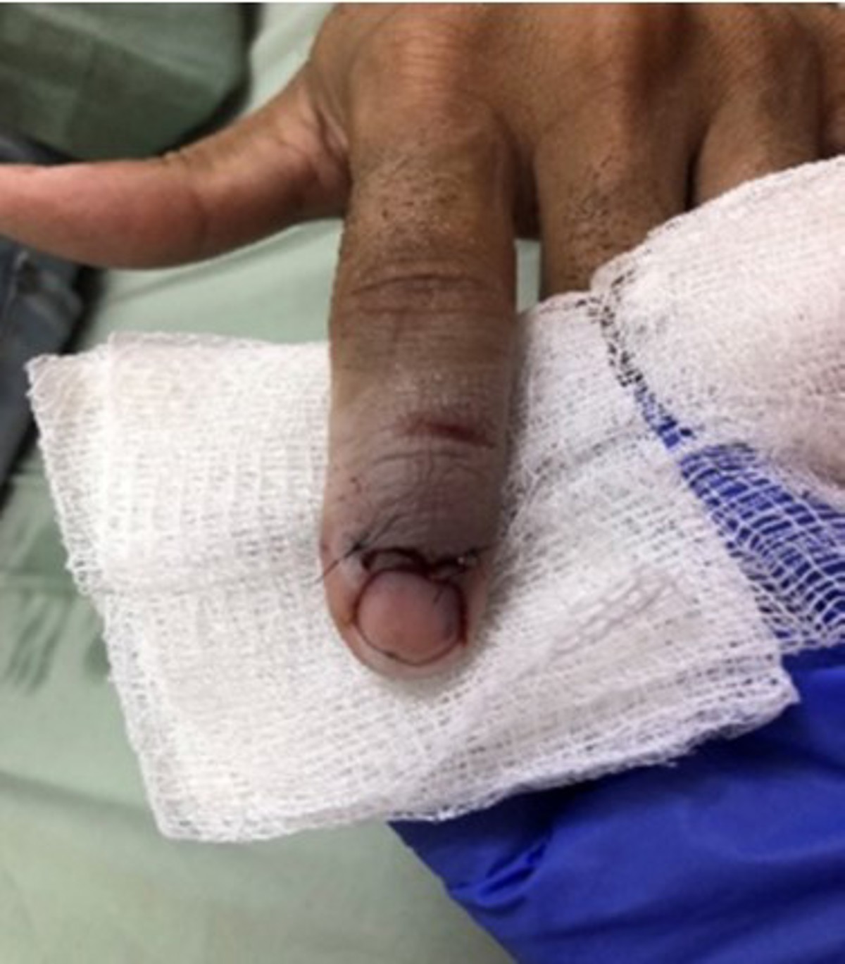 Crew member injured his finger while opening an emergency fire flap. As the last butterfly nut was released, one of the workers got his index finger accidentally jammed between the hatch door and the frame as his colleague was still pulling the hatch in the opposite direction. His finger was crushed; he was sent ashore to hospital, where X-rays revealed a broken finger