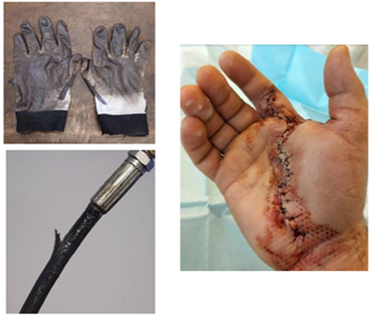 IMCA SF: MSF: Grease gun hand injury IMCA SF: MSF: Grease gun hand injury