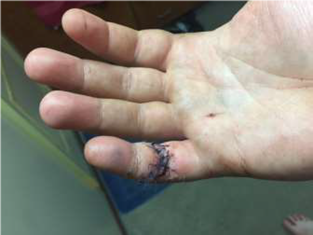 IMCA SF 08/17: Serious finger injury: Procedures during engine maintenance 81 The injured person’s right hand was holding the con rod off the crank pin in order not to damage the cylinder liner and crank pin/bottom end bearing shells.