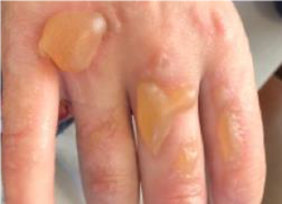 Consequence: First and second degree burns!