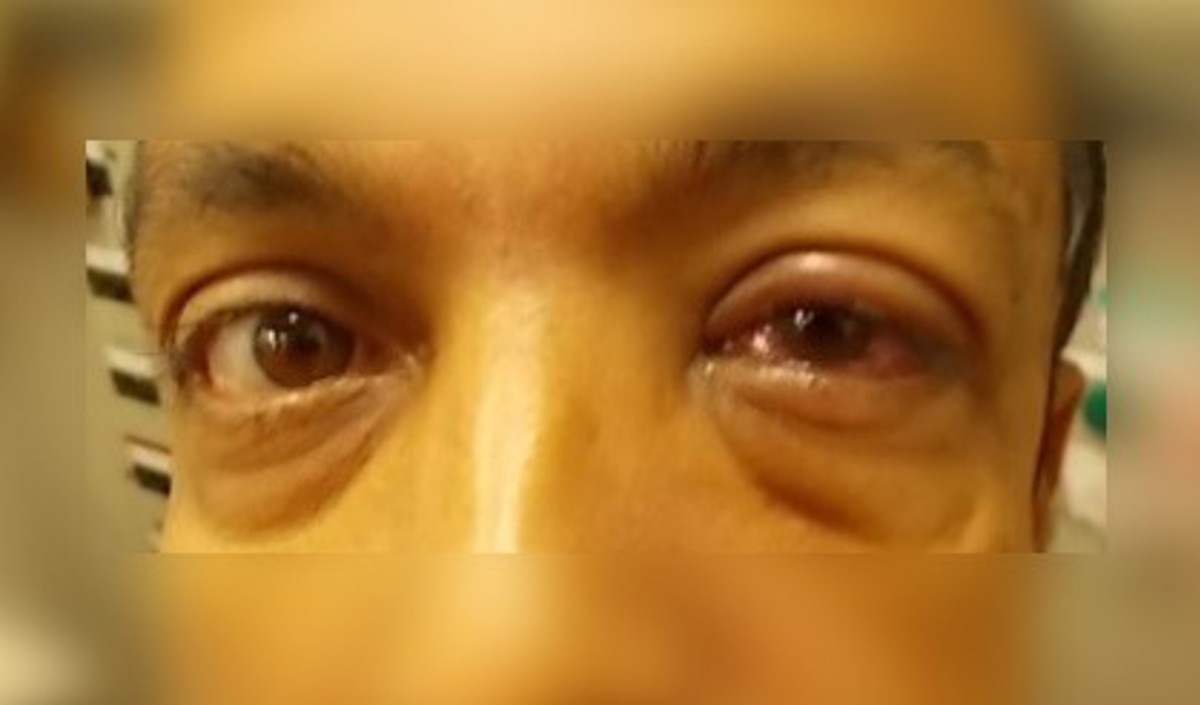 During the discharging of a cement tank on board a vessel, a crewman was standing in the path of a blow back of cement dust, and the dust got in his eyes.