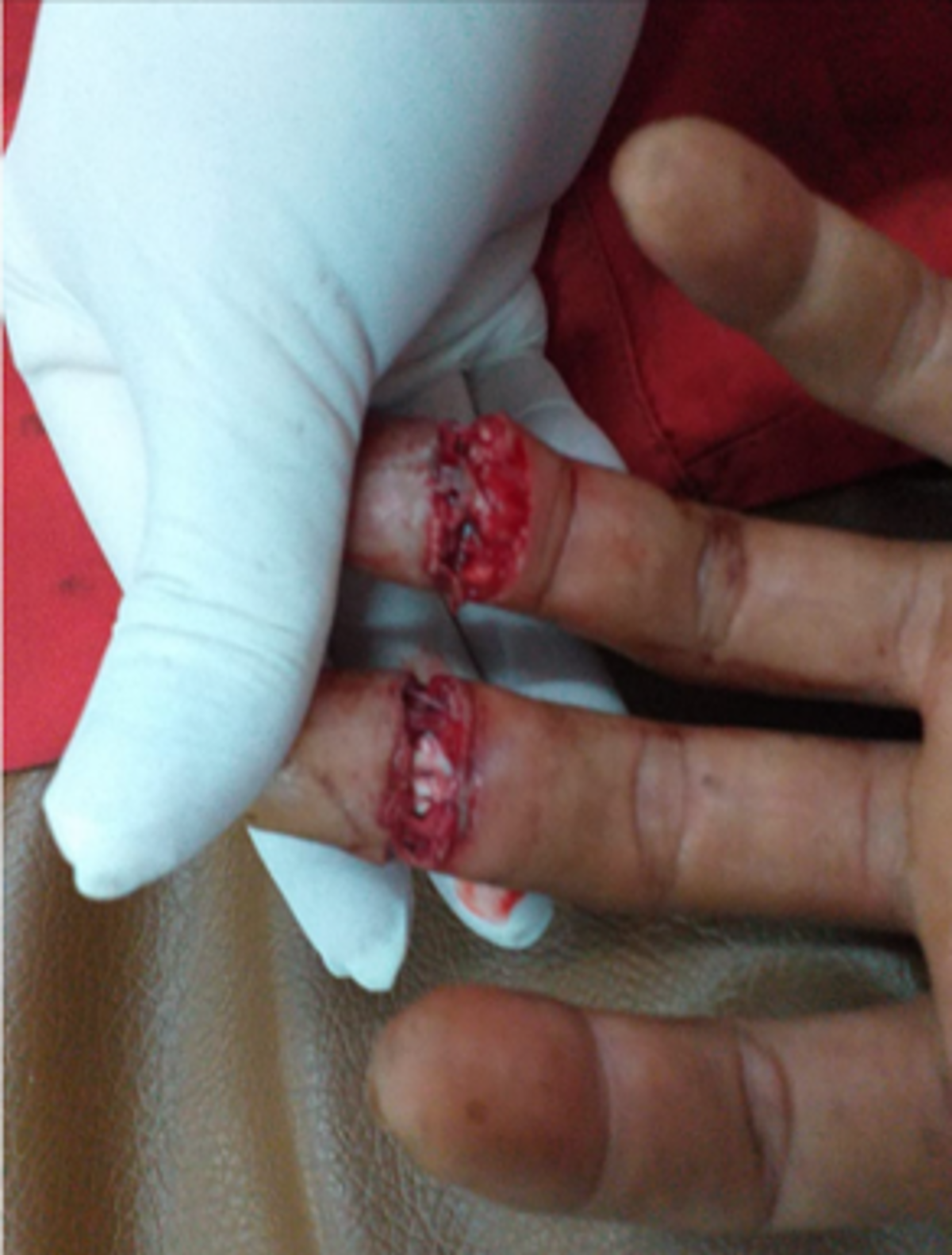 LTI: Serious hand injury – fingers lost in unexpected hatch closure