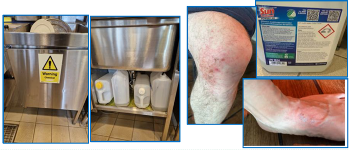 IMCA SF: Detergent chemical burn IMCA SF: Detergent chemical burn
