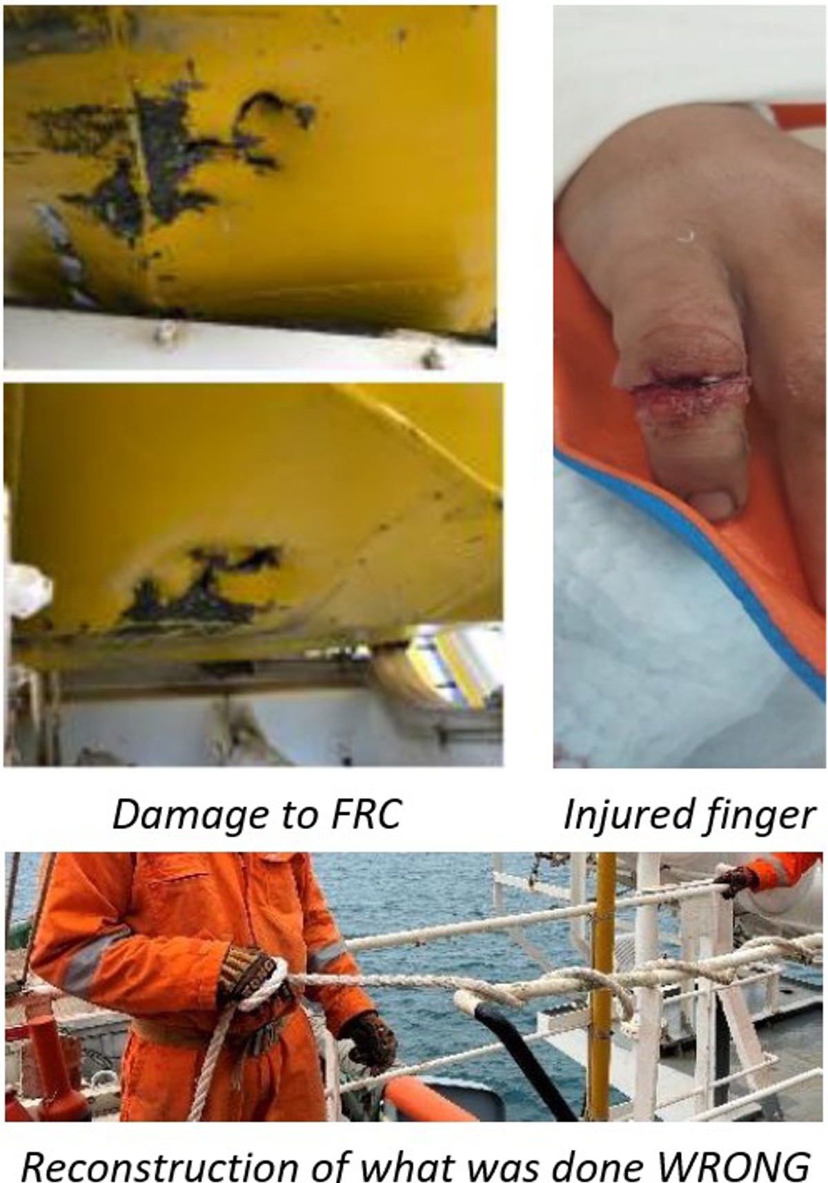 Photo block: Damage to FRC; Injured finger; and Reconstruction of what was done WRONG worker suffered a serious finger injury when his hand got caught between a painter rope under tension and the handrail. The incident occurred during testing of the rescue boat davit. He was holding the painter line, which was hitched to the handrail, coiled around his right hand. During the test, the winch brake system failed. This caused the FRC to fall. The crew members’ hand was stuck between the painter rope and the handrail. He suffered serious lacerations and compound fractures to his finger.
