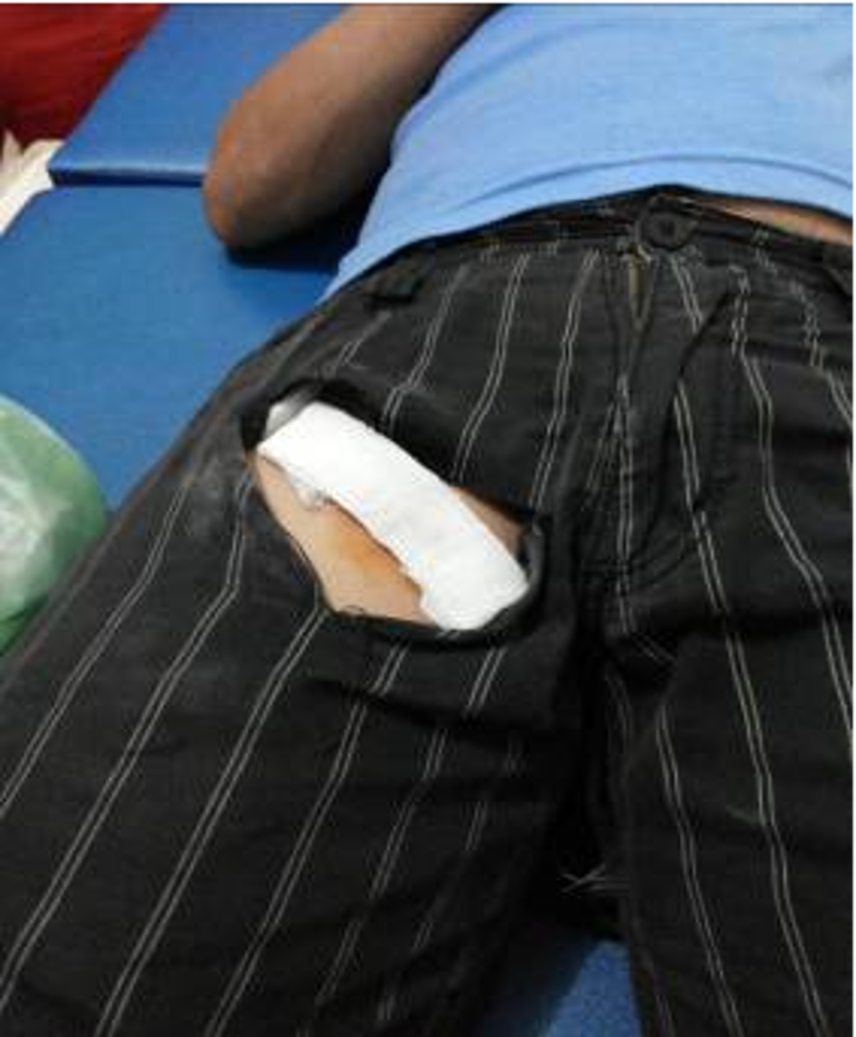 Injured area, right inner thigh