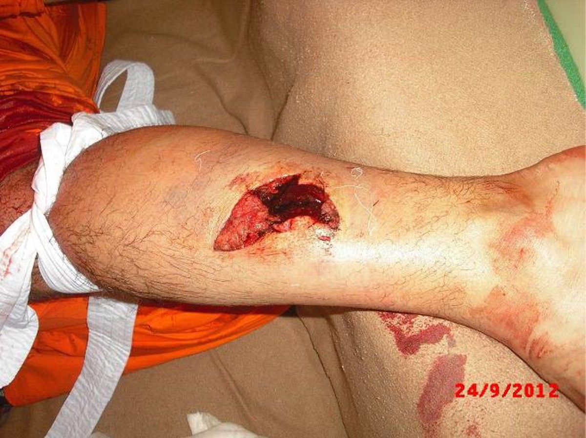 Injured person’s shin