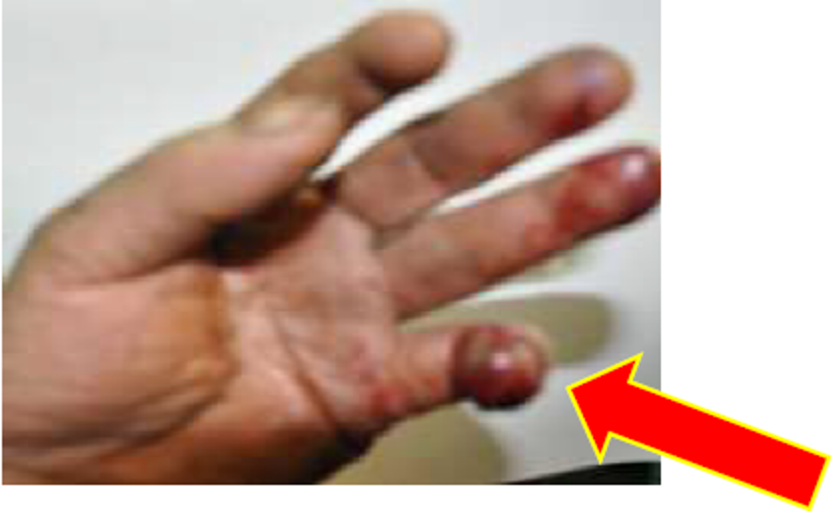 Finger crush injury