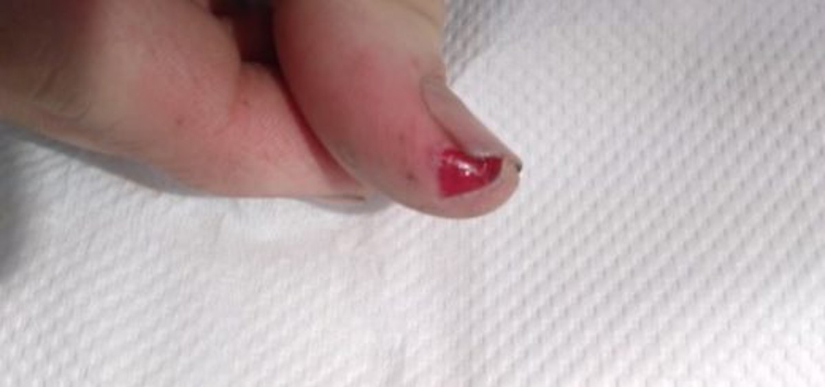 Photo of injured thumb