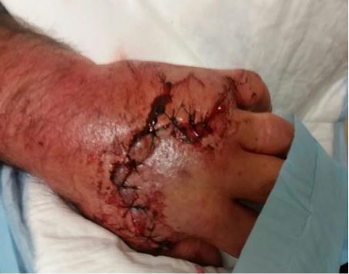 Hand injury