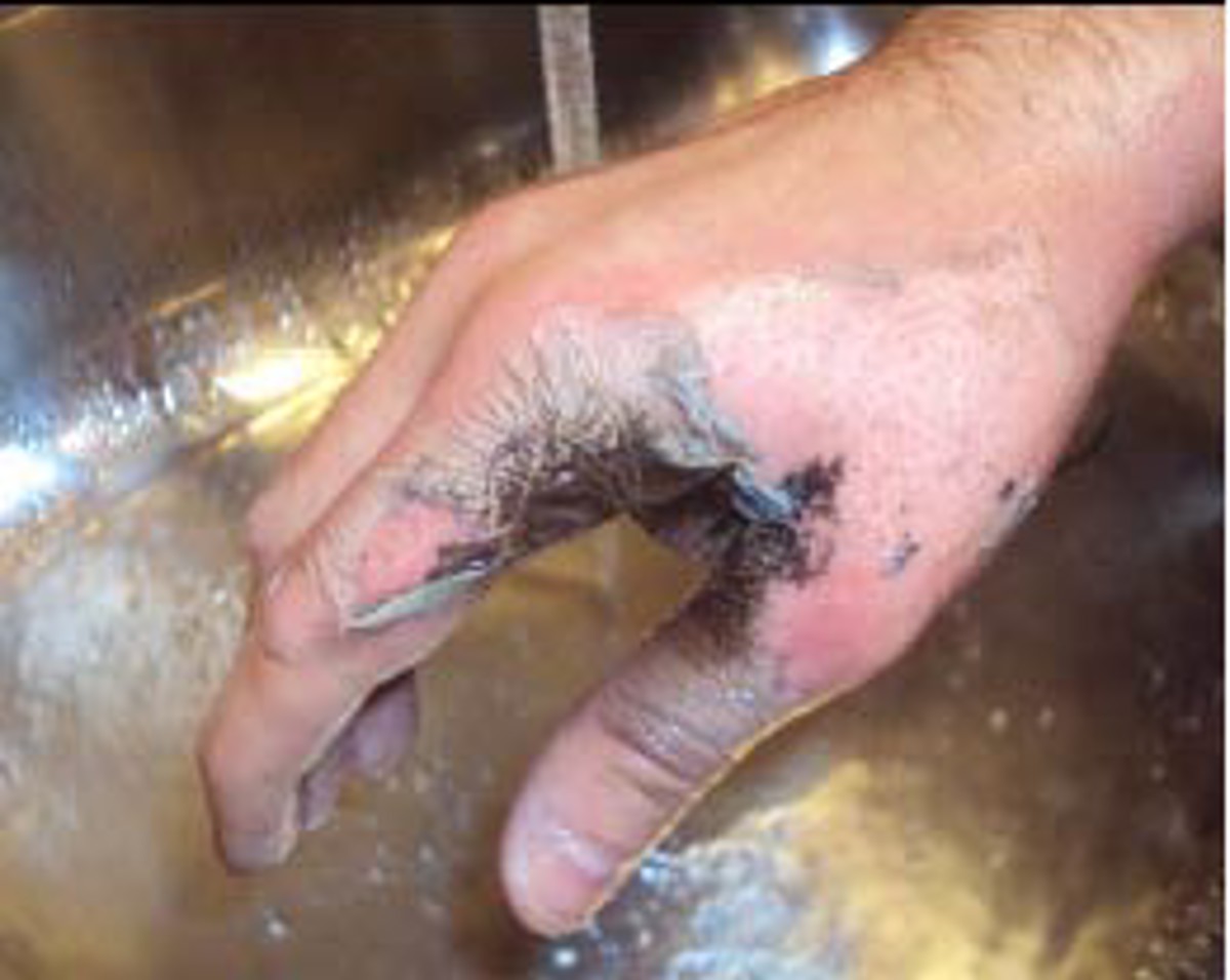 burn injury to hand