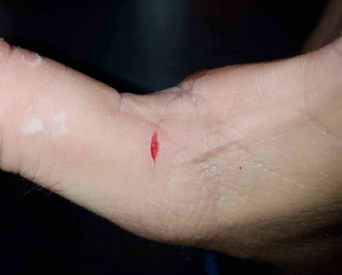 Cut hand