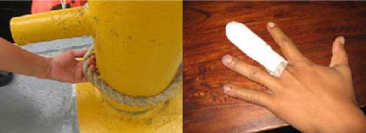 Finger injury whilst casting off towing line