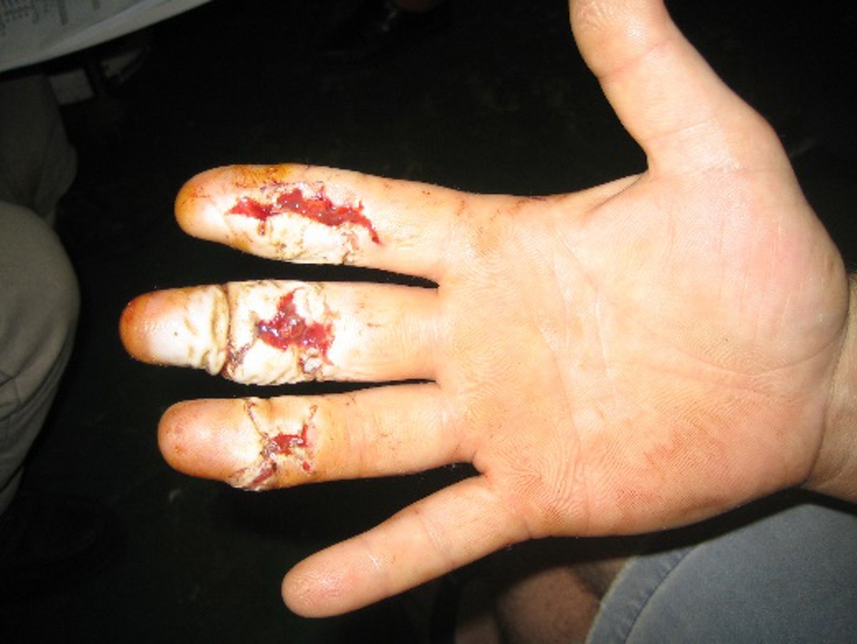 Diver’s hand after injury