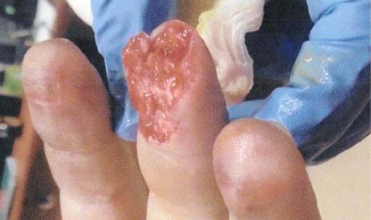 IMCA SF Serious finger injury during valve installation injured finger