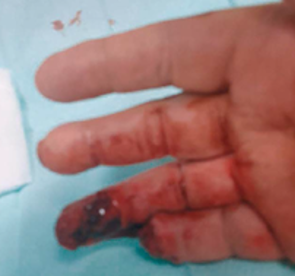 IMCA SF: MAIB: LTI – fingers lost during mooring operations