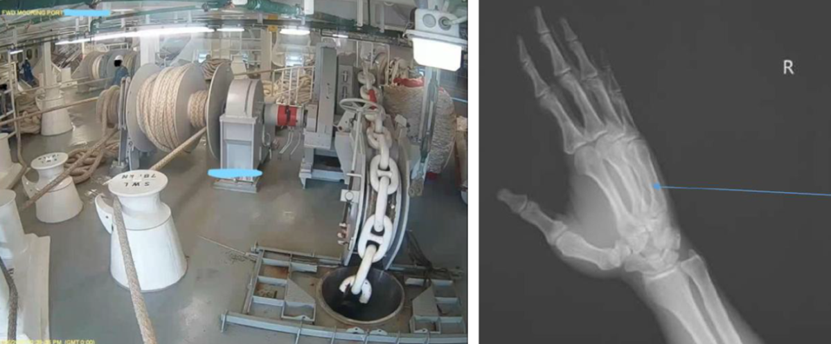 IMCA SF 20/19: LTI during mooring operations 14 1024X424 During mooring operations in the forward mooring deck of a large vessel, crew were in the process of sending out lines to line handlers ashore. When sending out the last breast line, they lost control and the line was slackened out in force. Despite shouted warnings to the contrary, the crewman closest to the line tried stopping it with his hands. The force of the line’s movement resulted in a hairline fracture to his right hand.